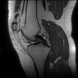 Acute-on-chronic transient lateral patellar dislocation with trochlear dysplasia (Radiopaedia 84099-99349 Sagittal PD 73).jpg