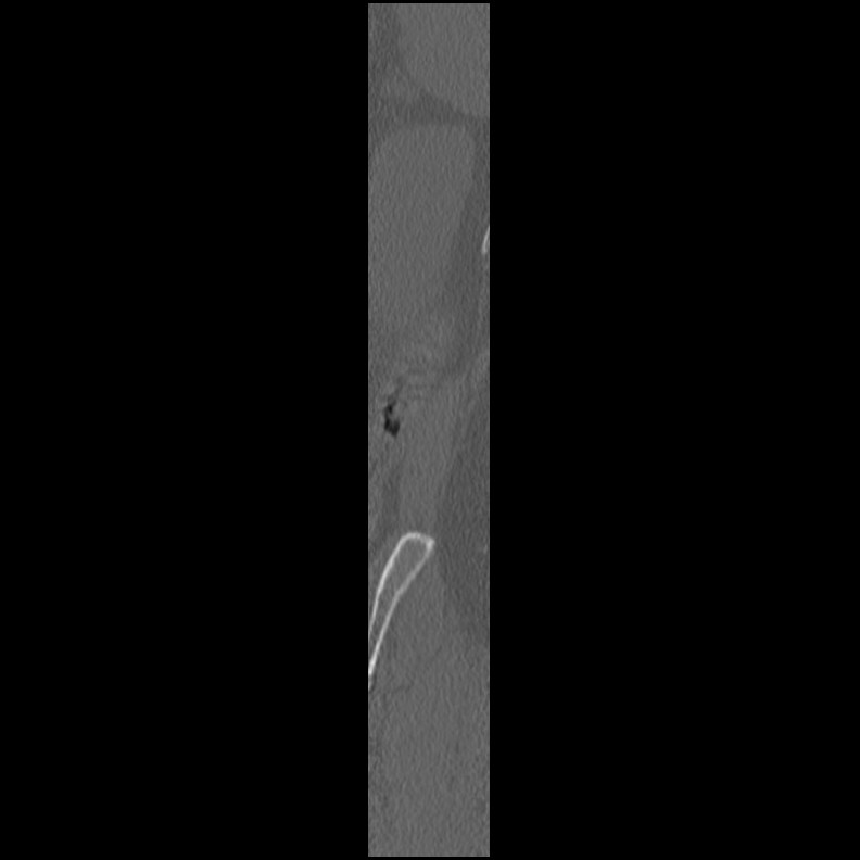 Acute Schmorl's node (Radiopaedia 83276-102365 Sagittal bone window 1).jpg