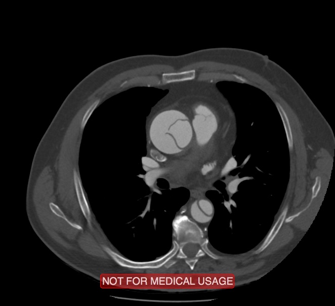 Acute aortic dissection - Stanford type A (Radiopaedia 40661-43285 Axial C+ arterial phase 29).jpg