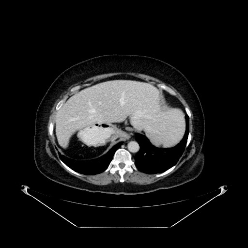 Acute appendicitis, heterotaxy syndrome (Radiopaedia 66884-76202 Axial C+ portal venous phase 25).jpg