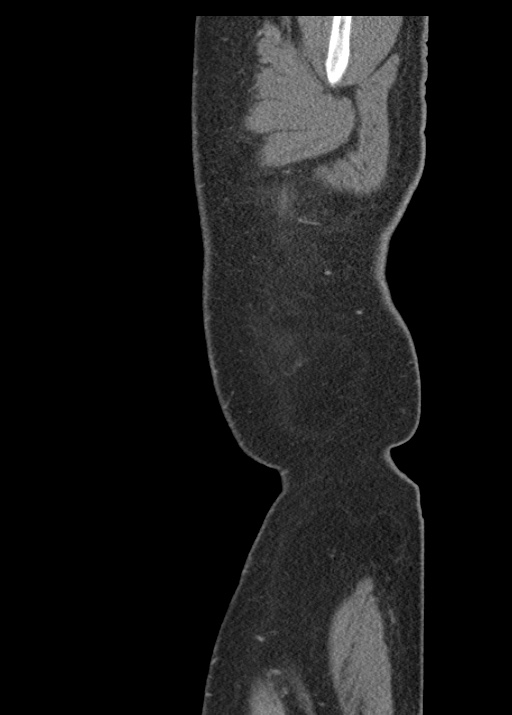 Acute appendicitis (Radiopaedia 48511-53463 Sagittal C+ portal venous phase 13).jpg