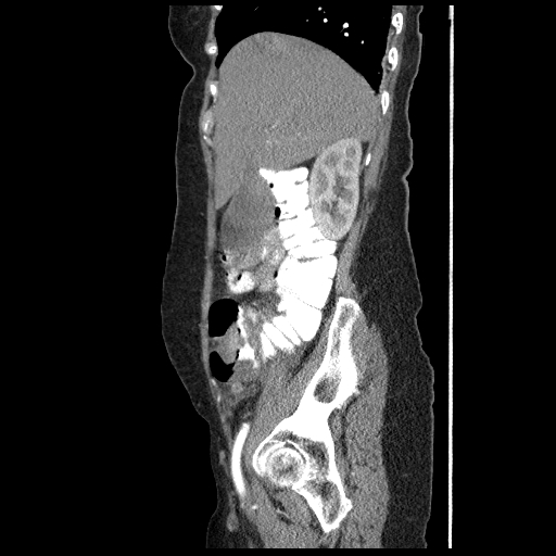 File:Acute appendicitis (Radiopaedia 52672-58589 Sagittal C+ arterial phase 30).jpg