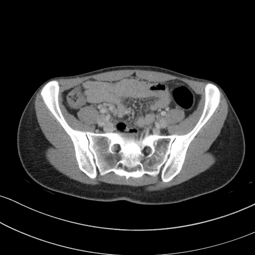 Acute appendicitis (Radiopaedia 62608-70901 Axial C+ portal venous phase 17).jpg