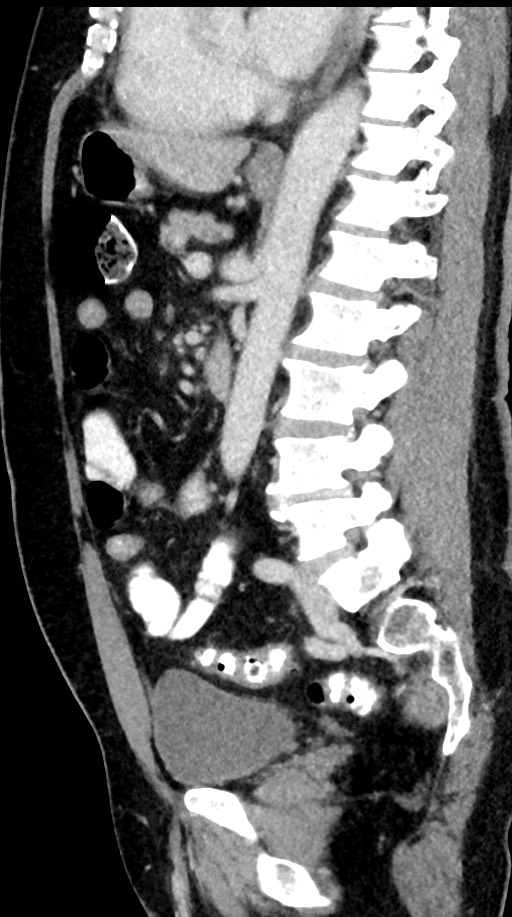 Acute appendicitis (Radiopaedia 77016-88960 Sagittal C+ portal venous phase 51).jpg