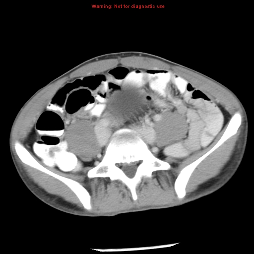 Acute appendicitis (Radiopaedia 8195-9045 Axial C+ portal venous phase 50).jpg