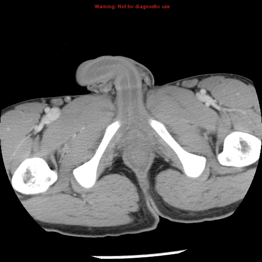 Acute appendicitis (Radiopaedia 8195-9045 Axial C+ portal venous phase 82).jpg