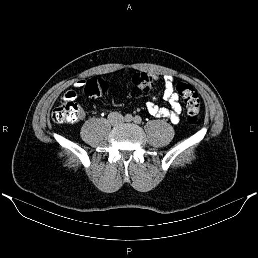 File:Acute appendicitis (Radiopaedia 84780-100240 Axial C+ delayed 69).jpg