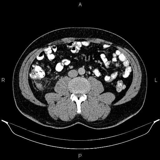 File:Acute appendicitis (Radiopaedia 84780-100240 Axial C+ portal venous phase 59).jpg