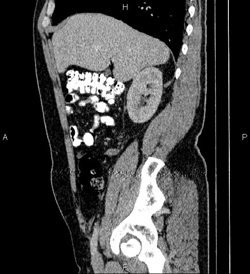 File:Acute appendicitis (Radiopaedia 84780-100240 Sagittal C+ portal venous phase 29).jpg
