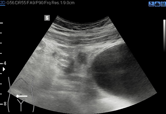 File:Acute appendicitis (Radiopaedia 85193-100745 B 157).jpg