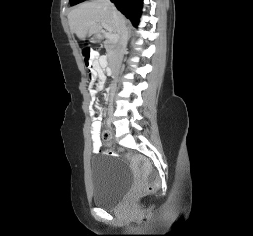 File:Acute appendicitis (Radiopaedia 9417-10099 Sagittal C+ portal venous phase 3).jpg