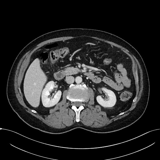 Acute appendicitis - large appendicoliths (Radiopaedia 61805-69820 Axial C+ portal venous phase 53).jpg