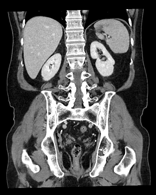 Acute appendicitis - large appendicoliths (Radiopaedia 61805-69820 Coronal C+ portal venous phase 94).jpg