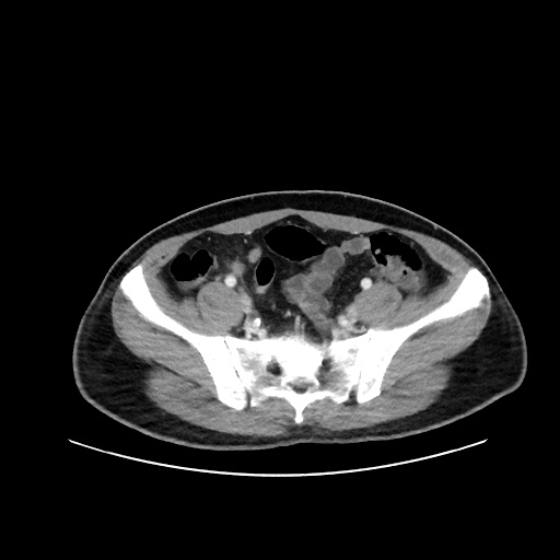Acute appendicitis and COVID 19 pneumonia (Radiopaedia 76604-88380 Axial C+ portal venous phase 65).jpg
