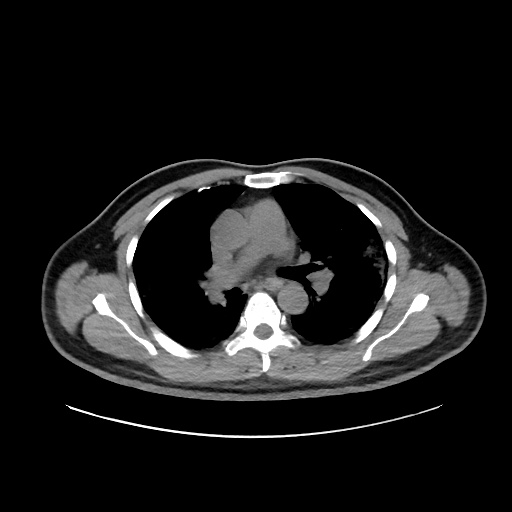 Acute appendicitis and COVID 19 pneumonia (Radiopaedia 76604-88380 Axial non-contrast 25).jpg