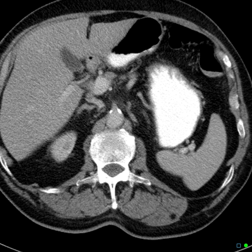 File:Acute appendicitis arising from a malrotated cecum (Radiopaedia 19970-19997 Axial C+ portal venous phase 1).jpg