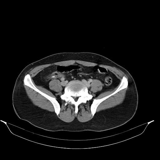 File:Acute appendicitis with appendicoliths (Radiopaedia 21148-21062 Axial C+ portal venous phase 12).jpg