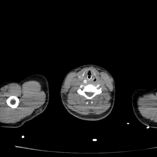 Acute aspiration pneumonitis (Radiopaedia 33605-34703 Axial non-contrast 4).jpg