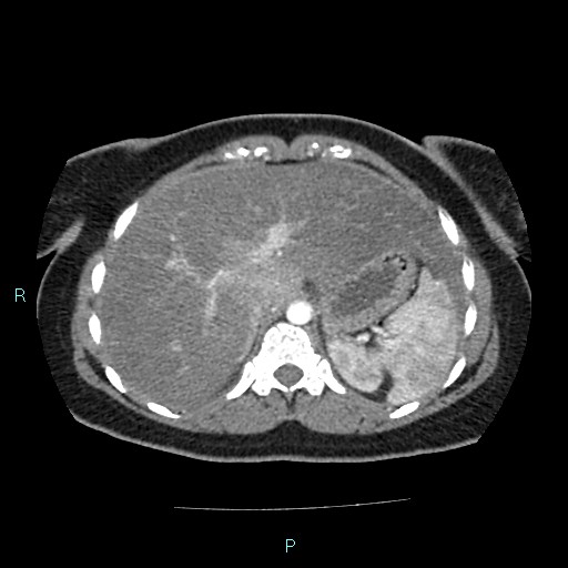 Acute bilateral pyelonephritis (Radiopaedia 37146-38881 Axial C+ arterial phase 34).jpg