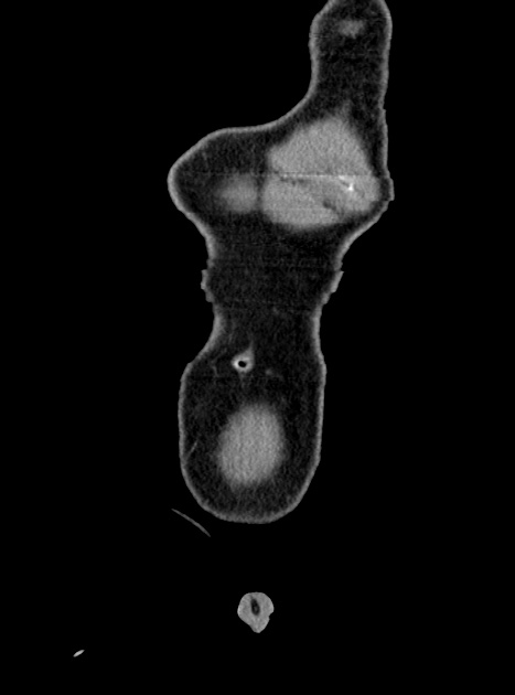 Acute bowel ischemia (Radiopaedia 87695-104114 Coronal C+ portal venous phase 59).jpg
