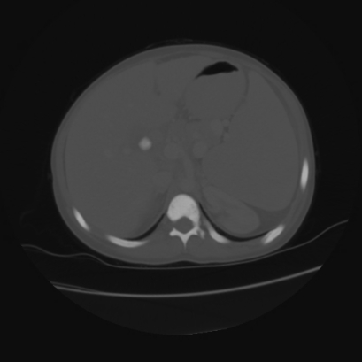 File:Acute calculous cholecystitis in patient with osteopetrosis (Radiopaedia 77871-90159 Axial bone window 14).jpg
