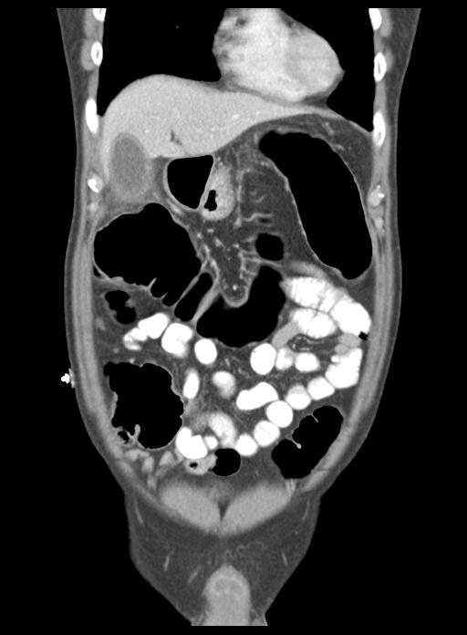 Acute cholecystitis (Radiopaedia 29814-30327 Coronal C+ portal venous phase 15).jpg