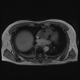 Acute cholecystitis (Radiopaedia 72392-82923 Axial T1 out-of-phase 10).jpg