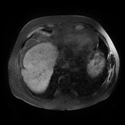 Acute cholecystitis complicated by pylephlebitis (Radiopaedia 65782-74915 Axial T1 fat sat 4).jpg