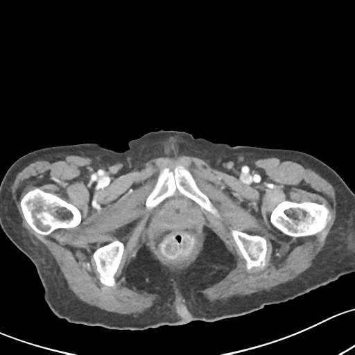 File:Acute cholecystitis with contained perforation (Radiopaedia 47328-51907 Axial C+ portal venous phase 76).png