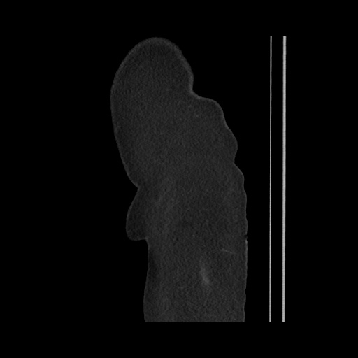 File:Acute cholecystitis with tensile fundus sign (Radiopaedia 71394-81723 Sagittal non-contrast 21).jpg