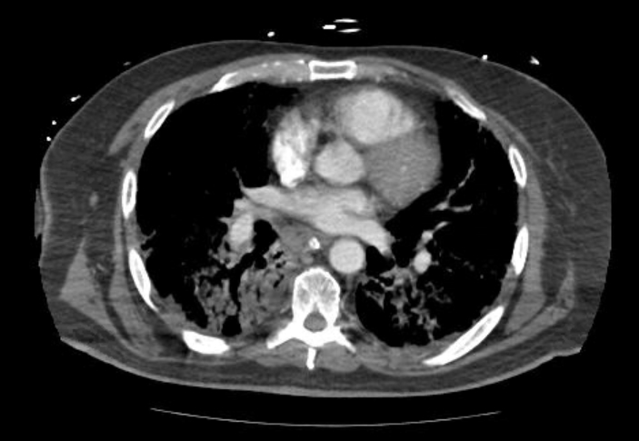 Acute cor pulmonale (ultrasound) (Radiopaedia 83508-98818 Axial C+ CTPA 42).jpg
