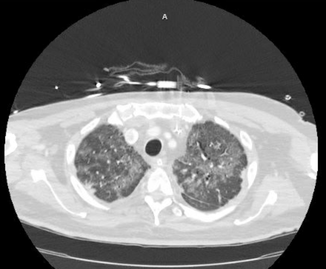 Acute cor pulmonale (ultrasound) (Radiopaedia 83508-98818 Axial lung window 20).jpg