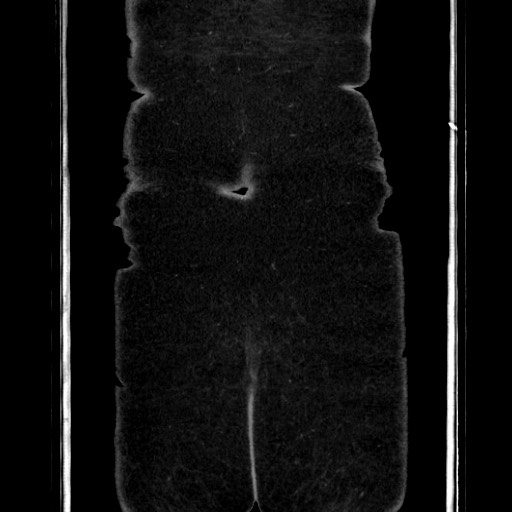 Acute diverticulitis - transverse colon (Radiopaedia 87063-103327 Coronal C+ portal venous phase 158).jpg