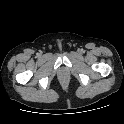 Acute diverticulitis with localized perforation (Radiopaedia 41296-44113 Axial C+ portal venous phase 95).jpg