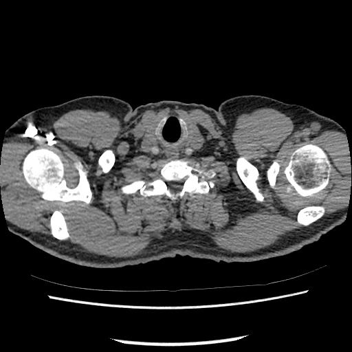 Acute epicardial fat necrosis (Radiopaedia 42327-45440 Axial C+ CTPA 7).jpg