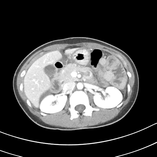 Acute gangrenous appendicitis with perforation (Radiopaedia 40152-42662 Axial C+ portal venous phase 23).png