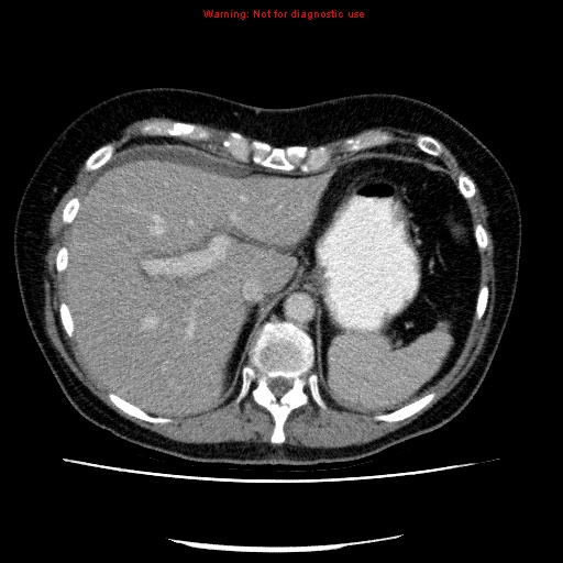 File:Acute gangrenous cholecystitis (Radiopaedia 10123-10661 Axial C+ portal venous phase 20).jpg