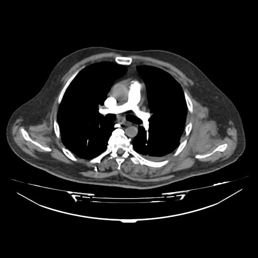 Acute heart failure (CT) (Radiopaedia 79835-93075 Axial C+ arterial phase 6).jpg