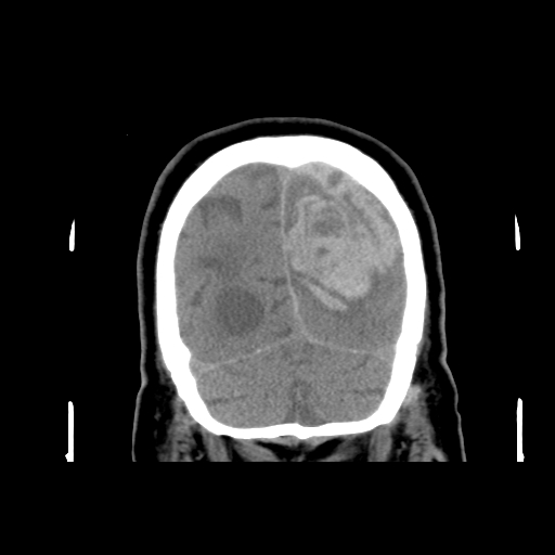 File:Acute hemorrhagic stroke (Radiopaedia 17507-17223 Coronal non-contrast 47).jpg