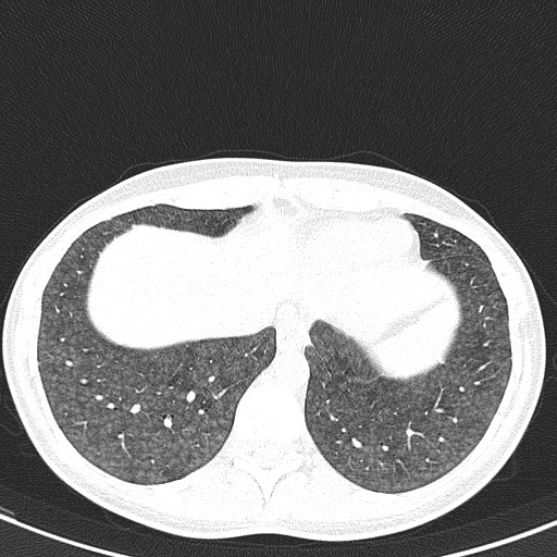 File:Acute hypersensitivity pneumonitis (Radiopaedia 85293-100870 Axial lung window 98).jpg