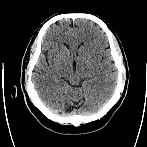 Acute left middle cerebral artery territory ischemic stroke (Radiopaedia 35688-37223 Axial non-contrast 34).png