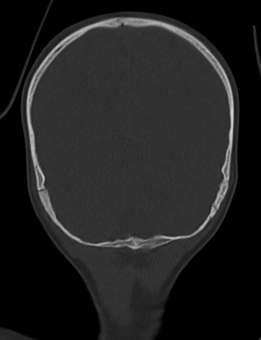 Acute mastoiditis (Radiopaedia 82678-96881 Coronal bone window 63).jpg