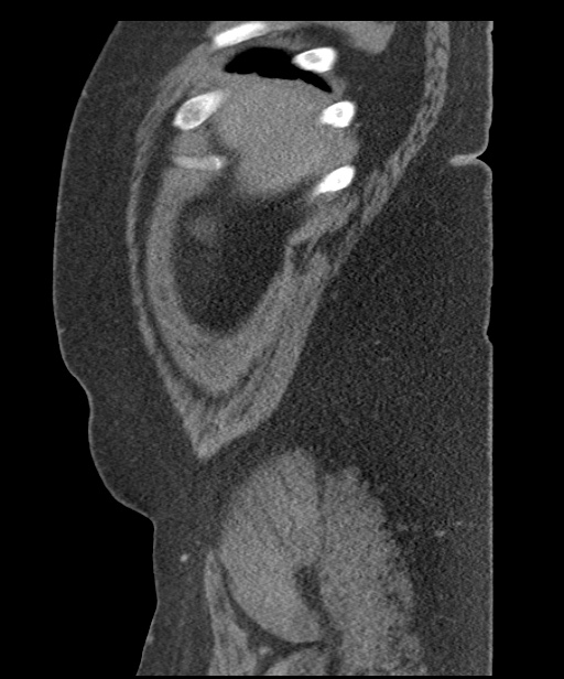 Acute mesenteric venous ischemia (Radiopaedia 46041-50383 Sagittal C+ portal venous phase 10).jpg