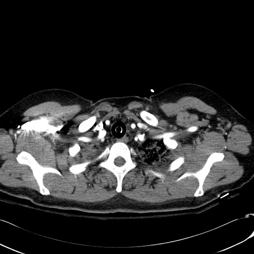 File:Acute myocardial infarction in CT (Radiopaedia 39947-42415 Axial C+ arterial phase 13).jpg