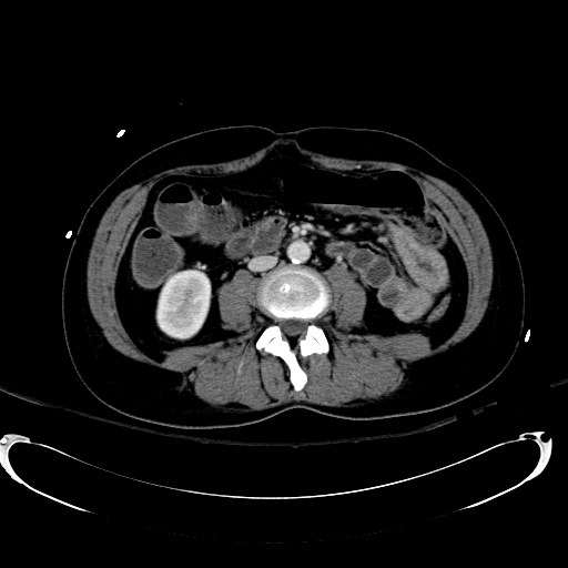 Acute myocardial infarction in CT (Radiopaedia 39947-42415 Axial C+ portal venous phase 69).jpg