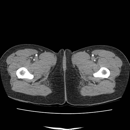 Acute myocarditis (Radiopaedia 55988-62613 Axial C+ portal venous phase 91).jpg