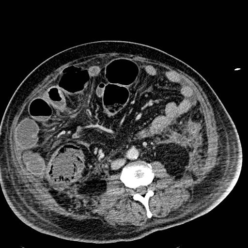 Acute pancreatic necrosis (Radiopaedia 13560-18501 Axial C+ portal venous phase 81).jpg