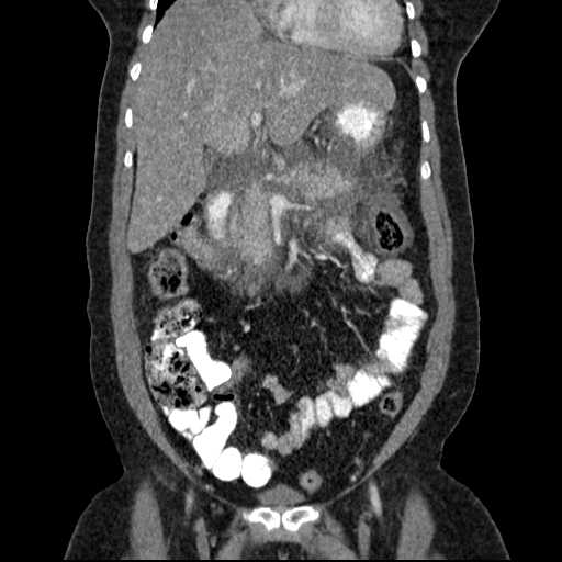 File:Acute pancreatitis (Radiopaedia 20829-20744 Coronal C+ portal venous phase 22).jpg