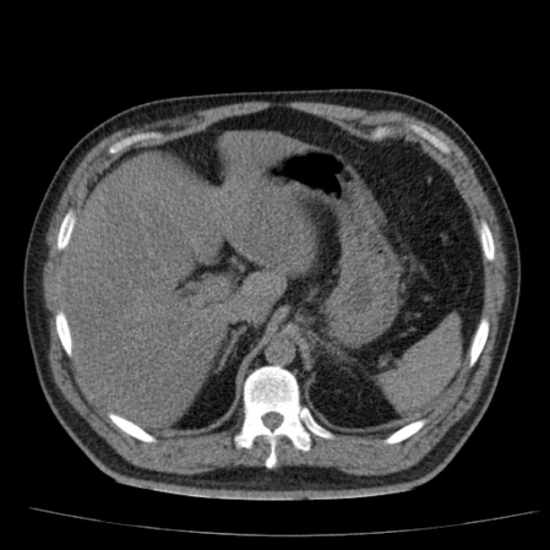 Acute pancreatitis (Radiopaedia 26663-26813 Axial non-contrast 26).jpg