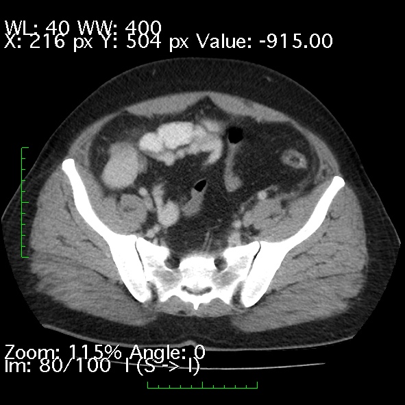 File:Acute pancreatitis (Radiopaedia 34043-35276 Axial C+ portal venous phase 80).jpg